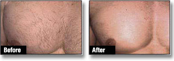 Male Laser Hair Removal