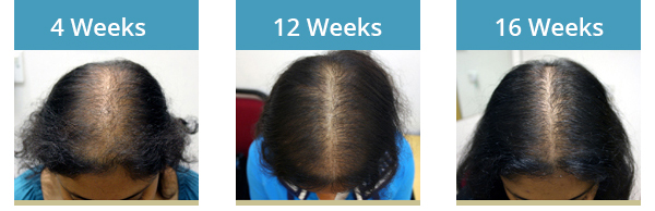 AQ Skin Solutions for hair loss treatment results